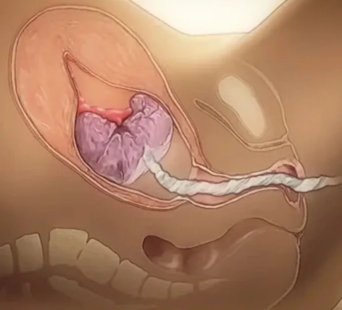 The Third Stage of Labour